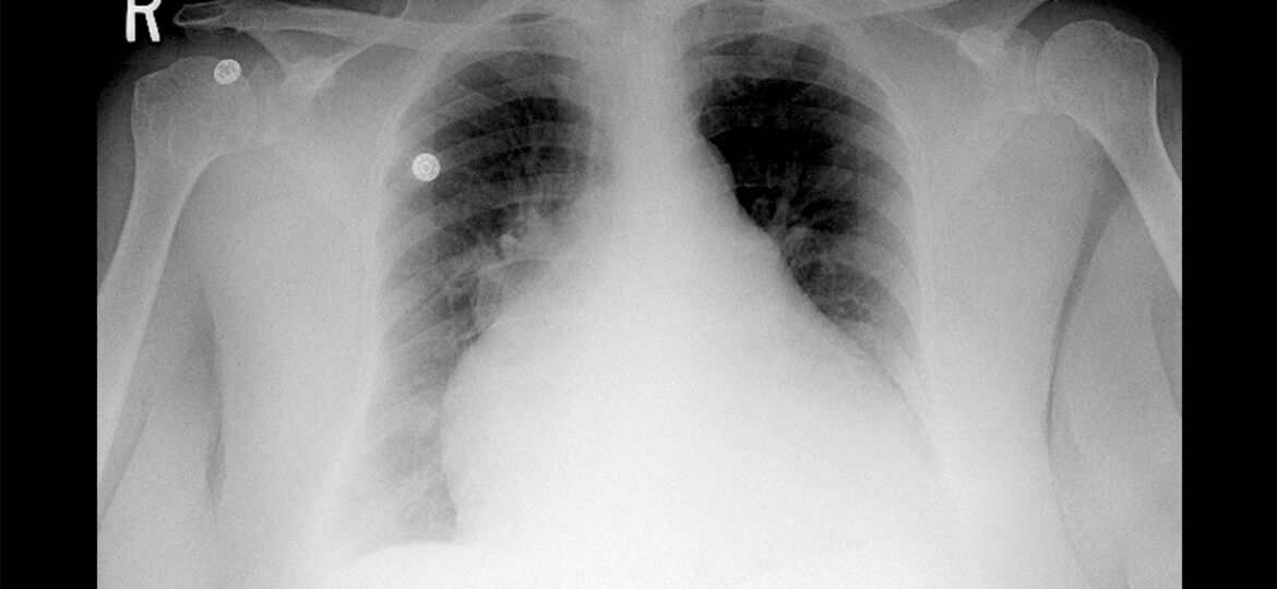 Unexplained Heart Enlargement May Be Causing Sudden Deaths in Obesity