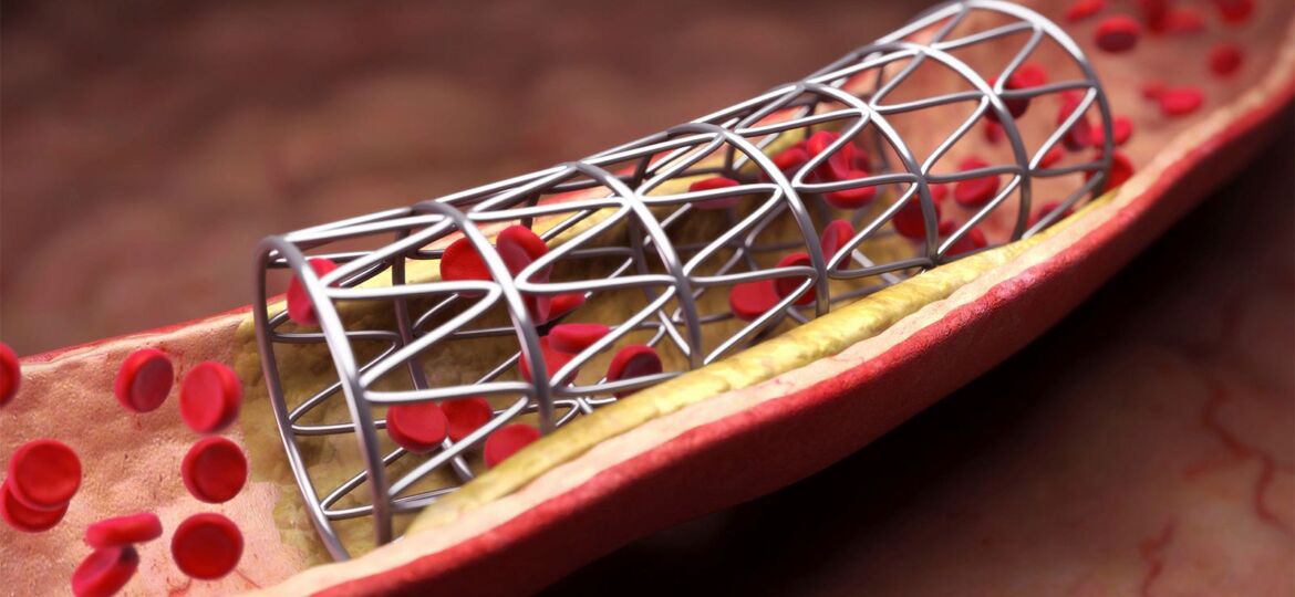 Silent Gastrointestinal Bleeds Track With Antiplatelet Choice After PCI