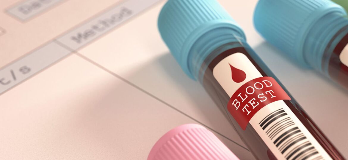 Use This Common Cardiac Test in RA Patients, Study Suggests