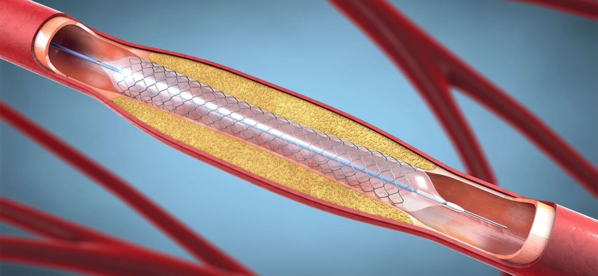 Novel Goalpost for PCI Excellence Is Borrowed From the Surgeons