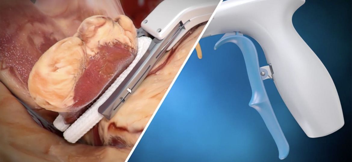 Cautious Optimism for Surgical LAA Closure for People Without Afib