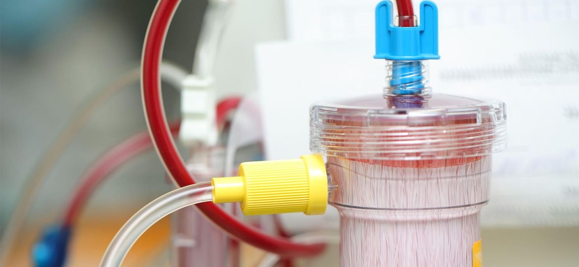 Cardiac Surgery-Associated AKI Lower With Extracorporeal Blood Purification