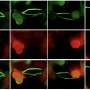 Fluorescence-guided imaging technique could improve head and neck cancer surgery