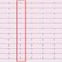 Cardiology collaboration advances machine learning predictions for AFib after stroke