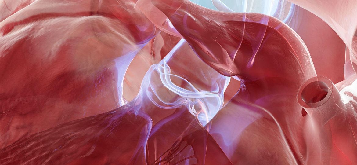 Aortic Stenosis Outcomes Worsen With Cardiac Amyloidosis Also in the Picture