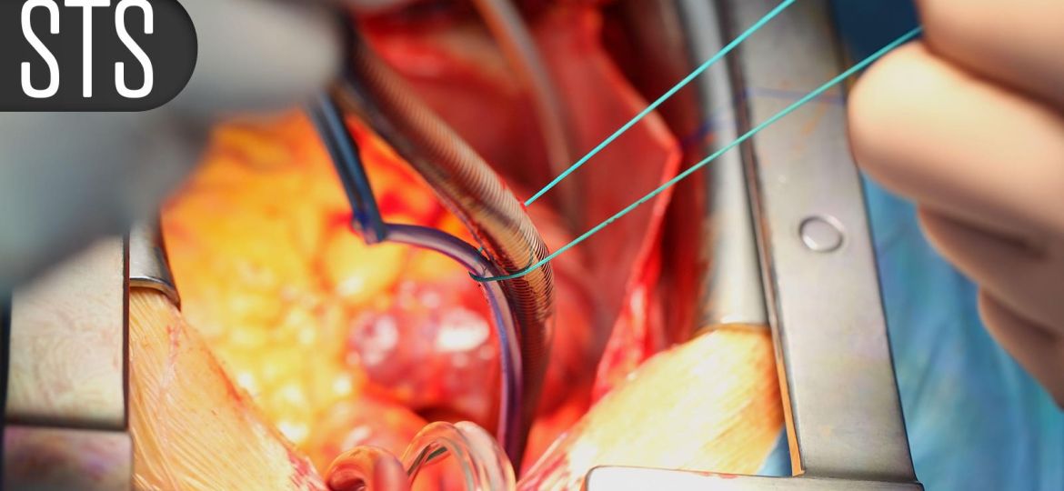 Heart Surgeons Wary of Being ‘Left Behind’ in Tricuspid Innovation