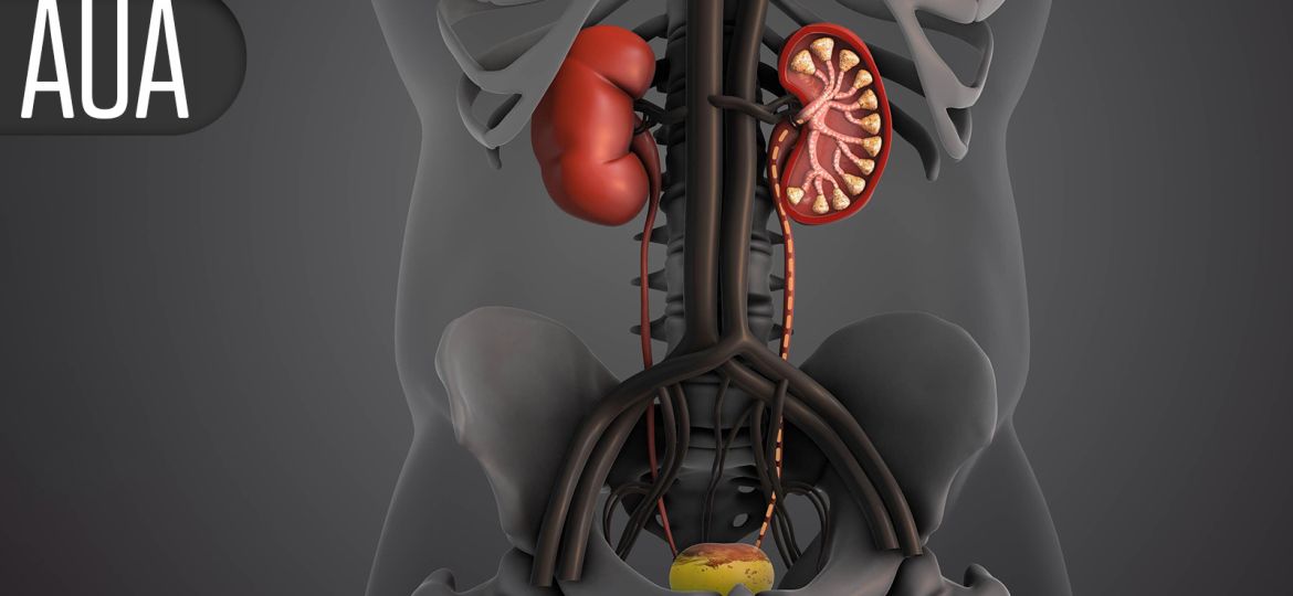Non-Ablative Intervention for BPH/LUTS Reduces Symptoms With Low Retreatment Rate