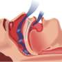 Treatment for obstructive sleep apnea lowers heart risk for some patients, increases risk for others