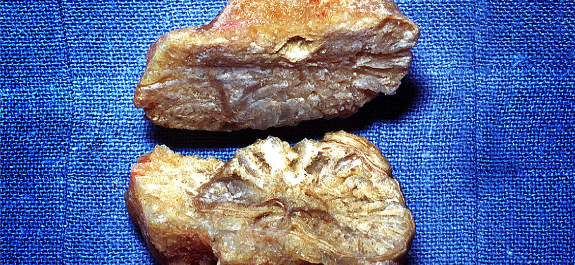 Trial Questions Fluid Intake Targets for Preventing Urinary Stone Recurrence