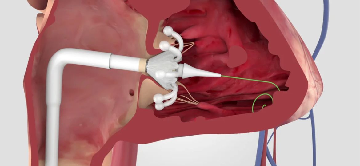 Real-World Practice Getting a Handle on Evoque TTVR, Registry Finds