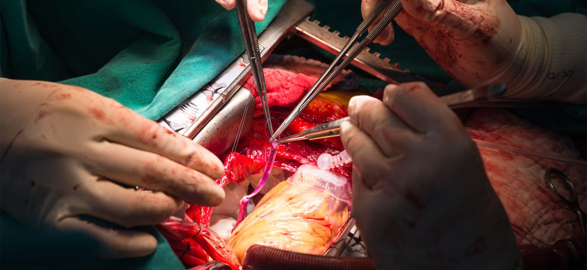 One Troponin Assay Would Suggest Whopping MI Incidence After Cardiac Surgery